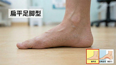 扁平足脚型图